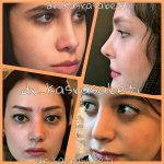 N Most Persian (Iranian) Rhinoplasty Patients, The Skin Thickness Is A Very Important Consideration