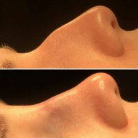 Nasal Hump Removal Can Be Performed Under General Or Local Anesthesia