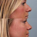 Nasal Hump removal is usually only part of a nose job