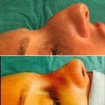 Nasal hump deformity before and after (1)