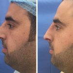 Nasal hump deformity before and after (2)