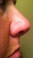 New Orleans, Louisiana Best Looking Nose By Michael H. Moses MD, FACS