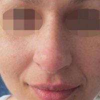 New Orleans Rhinoplasty For Long Nose Can Change Your Nose Size, Contour The Nasal Tip And Nostrils