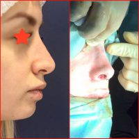 Newcastle Rhinoplasty Before And After Photos