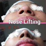 Non Surgical Korean Nose Job Before And After Photo