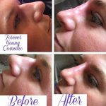 Nose Augmentation Before And After (1)