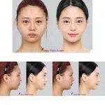 Nose Augmentation Before And After Images (2)