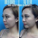 Nose Augmentation Filler Before And After