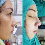 Nose Augmentation Injection Before And After