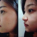 Nose Augmentation Rhinoplasty Before And After (1)