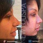 Nose Augmentation Rhinoplasty Before And After (4)