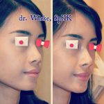 Nose Augmentation Without Surgery Before And After (3)