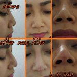Nose Bridge Augmentation Before And After