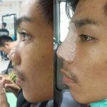 Nose Bridge Augmentation For Man (2)
