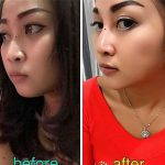 Nose Bridge Augmentation Surgery Before After