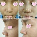 Nose Job Augmentation To Camouflage Deviations