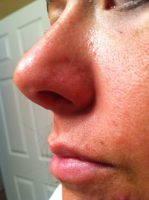 Nose Reshaping At The Harley Medical Group