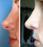 Nose Surgery NC Preop And Postop Results