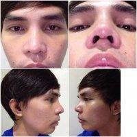 Nose Surgery in Mexico can be performed alone or be associated with other complementary interventions face