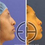 Nose beauty surgery to remove a dorsal hump