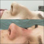 Nose job hump removal before and after photos (1)