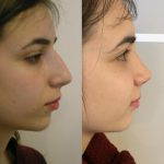 Nose job hump removal before and after photos (3)