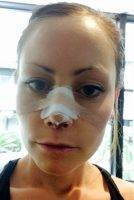 Nostril Plastic Surgery In Rochester MN May Be Used To Reconstruct The Nose For Medical Reasons