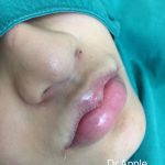 PLASTIC SURGERY For Nose IN SOUTH KOREA