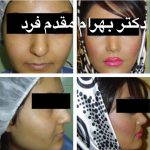Persian (Iranian) Rhinoplasty Is A Very Common Type Of Middle Eastern Cosmetic Nose Surgery