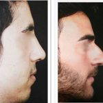 Persian Nose Job Before And After (1)