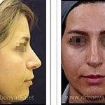 Persian Nose Job Before And After (2)