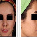 Persian Rhinoplasty Before After (10)