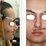 Persian Rhinoplasty Before After (11)