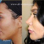 Persian Rhinoplasty Before After (2)