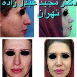 Persian Rhinoplasty Before After (4)
