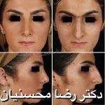 Persian Rhinoplasty Before After (5)