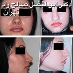 Persian Rhinoplasty Before After (6)