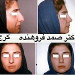 Persian Rhinoplasty Before After (7)