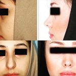 Persian Rhinoplasty Before After (8)