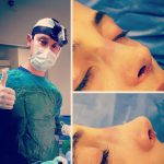 Photo of nose hump removal procedure