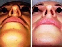 Photos Of Rhinoplasty Before And After In India