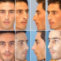 Plastic Surgery Male Nose Tip In New Orleans Louisiana Images Before And After