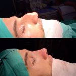 Plastic surgery for nose is a very difficult procedure especially when you need nasal hump removing