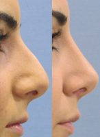 Removing A Nose Hump Is A Very Common Operation