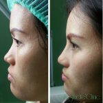 Rhinoplasty Bridge Augmentation Picture Before And After