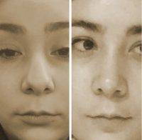 Rhinoplasty Free Before And After Photo