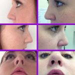 Rhinoplasty To Help Restore A More Normal Alignment