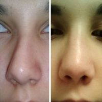 Septoplasty With Turbinectomy Before And After Photo