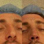 Straightening Crooked Nose After Injury