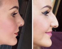 The Only Way To Remove A Nasal Hump Is With Nose Job Surgery